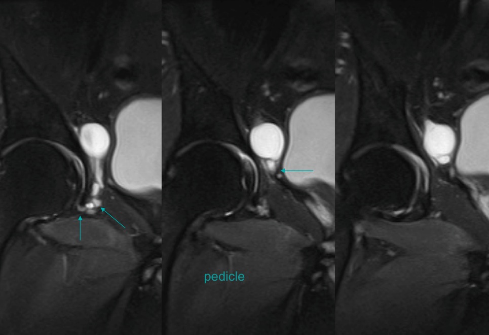 Figure 4 for case Obturator nerve impinge by ganglion cyst